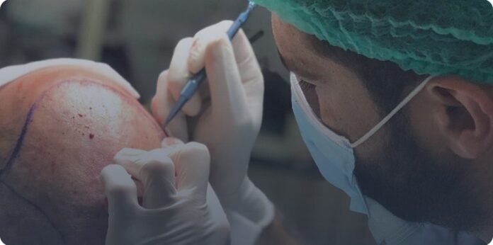 Hair Transplant